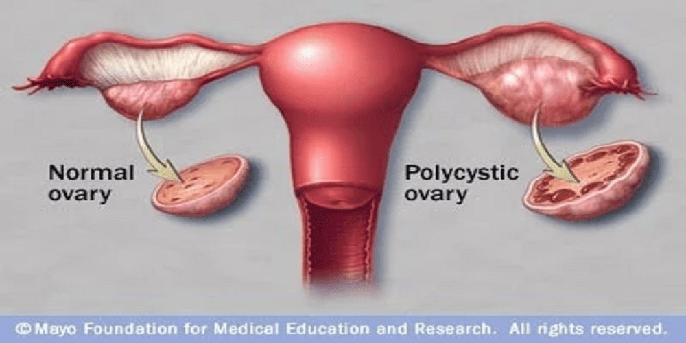 Polyendocrine Metabolic Ovarian Syndrome: New Name to Improve Diagnosis and Care of Condition Affecting 170 Million Women Worldwide